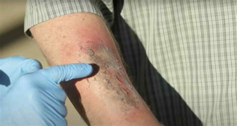 what to do if you touch battery acid|Battery Acid on Skin: Symptoms,。